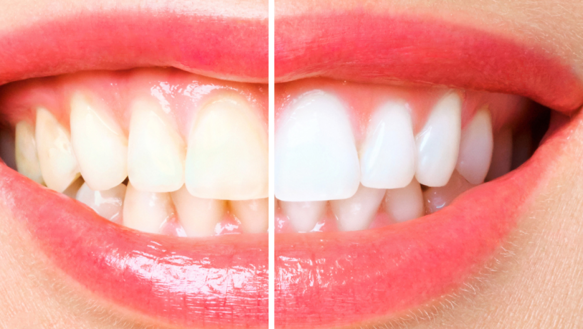 חולמים על שיניים לבנות וצחורות? טיפול הלבנת שיניים זה הפתרון המושלם עבורכם